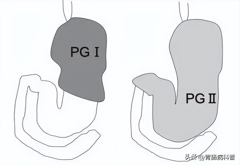 胃癌筛查除了胃镜还有什么方式,担心胃癌又不想做胃镜三步筛查