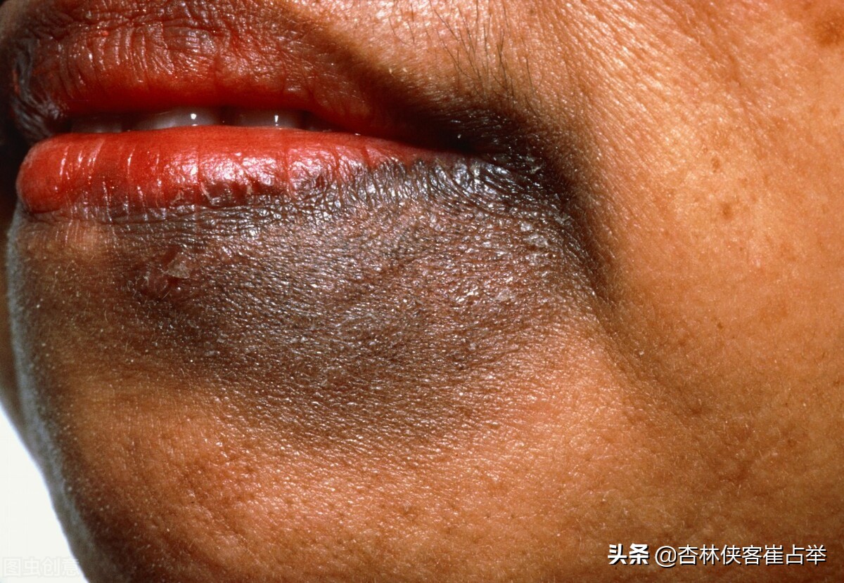 脸上长斑吃什么中药调理祛斑,脸上长斑需要怎么活血化瘀