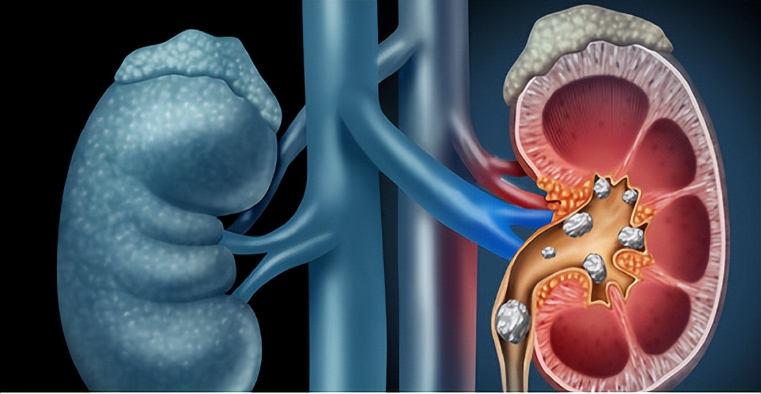 肾结石能吃蛋一类的食物吗,肾结石治疗期间可以吃鸡蛋吗