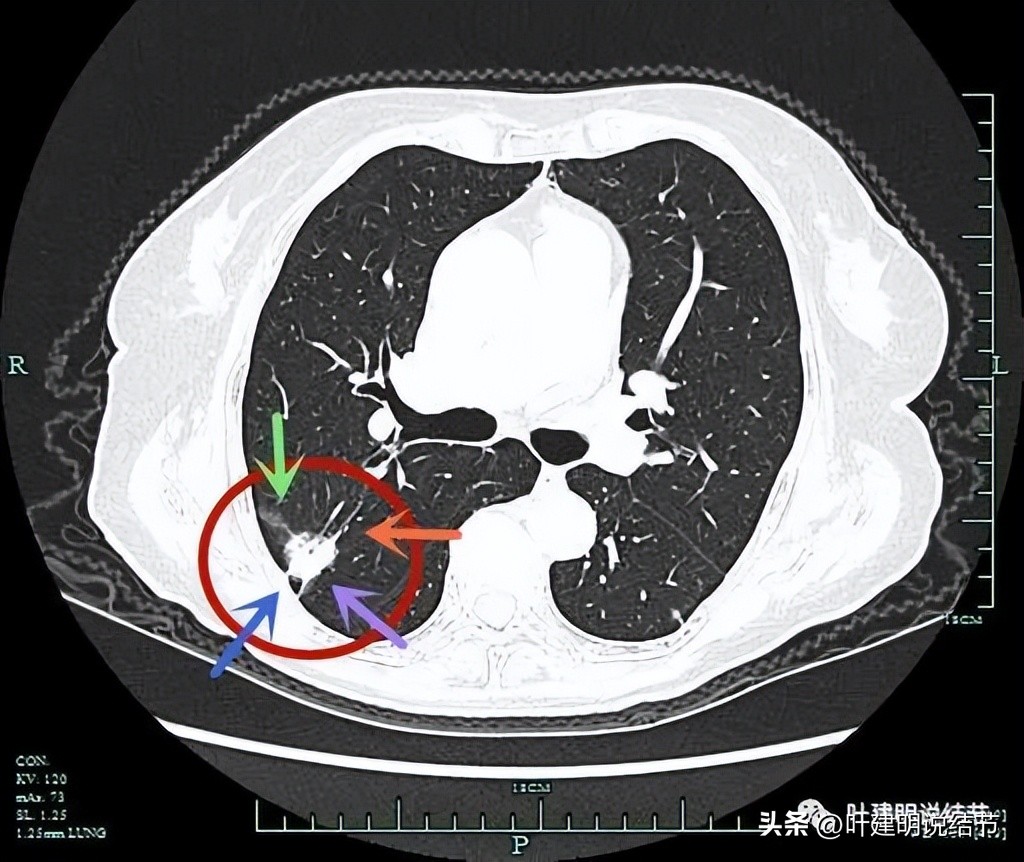 79岁肺癌早期手术风险,75岁早期浸润性肺癌还要治疗吗