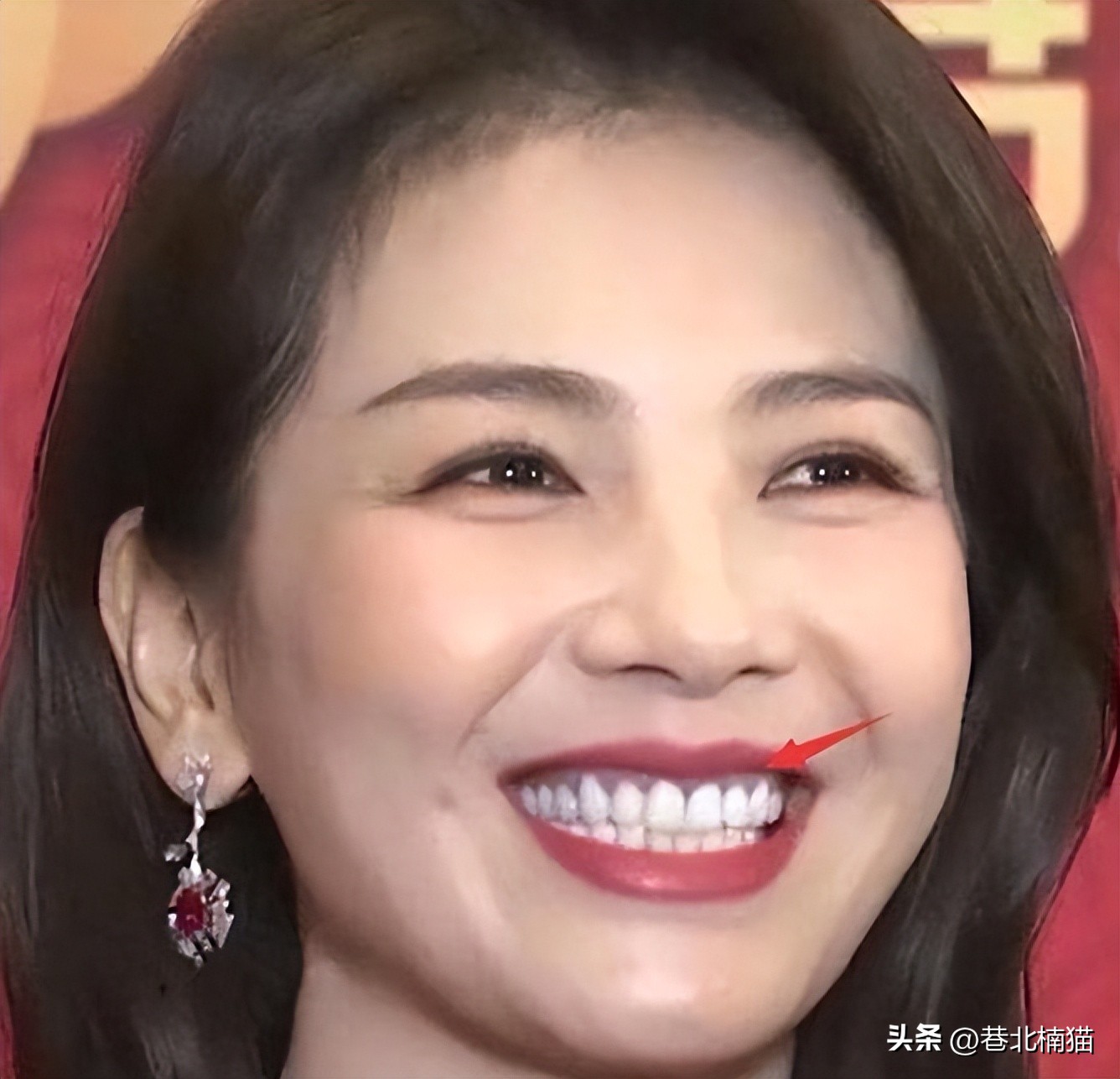 明星嘴突戴牙套前后对比,明星和假牙