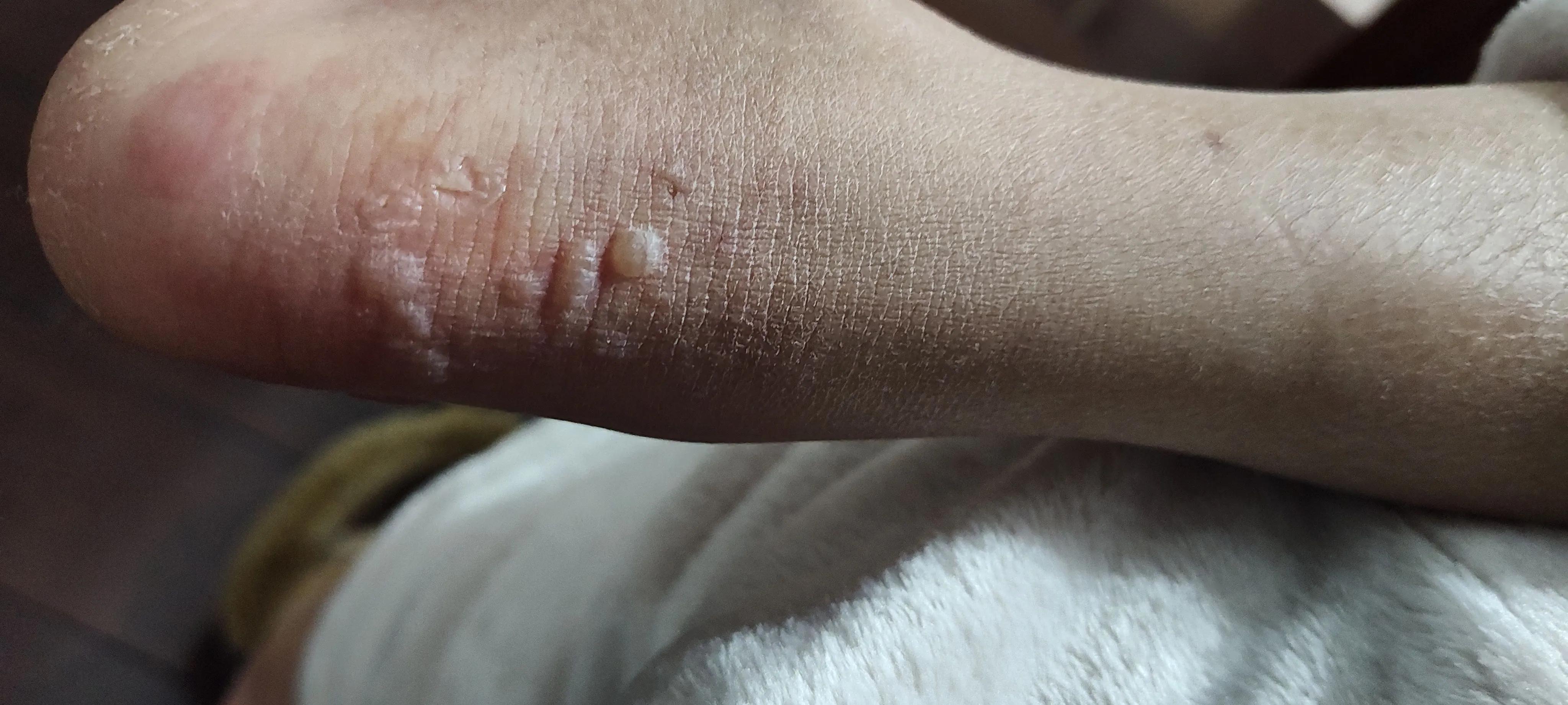 脚后跟红肿皮干,脚后跟红肿用什么药治疗