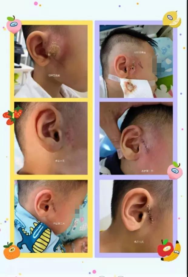 耳前瘘管可以用什么药膏,耳前瘘管引流后一直有脓