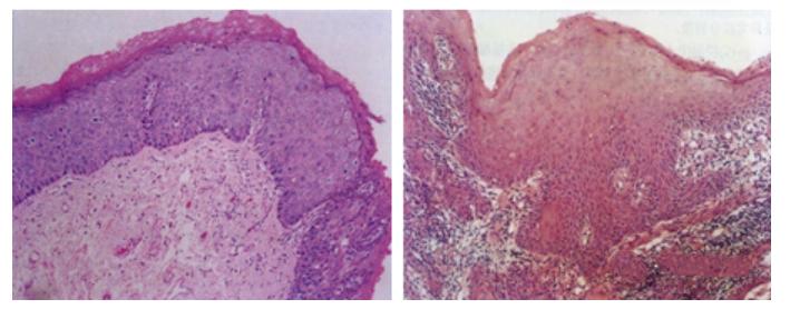 派特生物能治宫颈湿疣吗,派特灵妇科