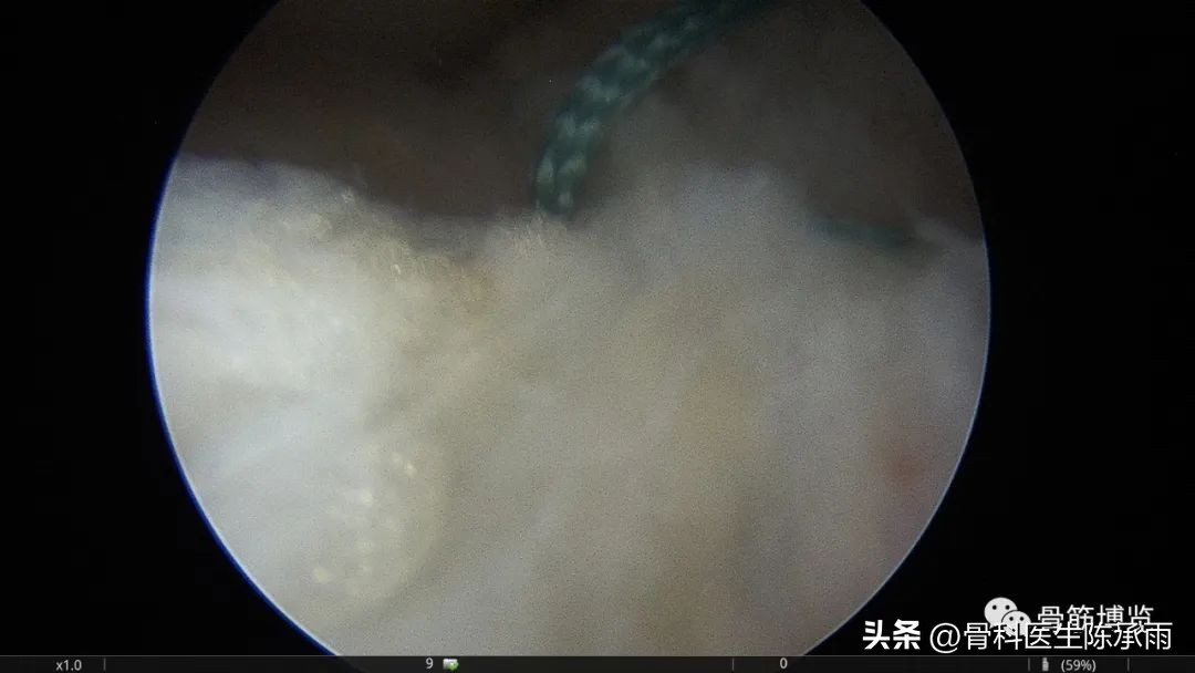 内侧半月板前角囊肿,关节镜下内侧半月板部分切除术
