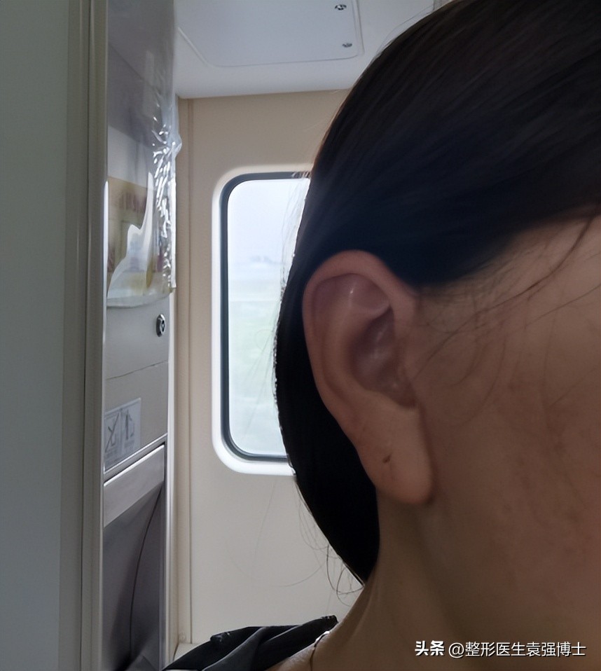 做大拉皮真的显年轻几岁吗,北京做大拉皮前后对比照片图文