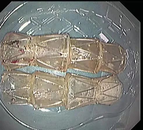 潍坊市人民医院专家为您讲解：什么是吻合口瘘？