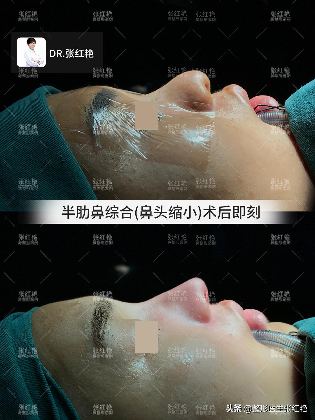 缩鼻翼怎么不留疤,缩鼻翼疤痕凸起