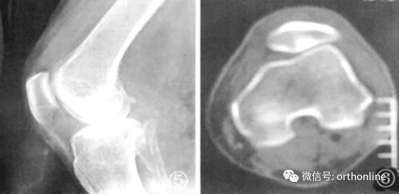 髌骨软化症的最佳疗法是什么,髌骨软化症治疗方法以及康复训练