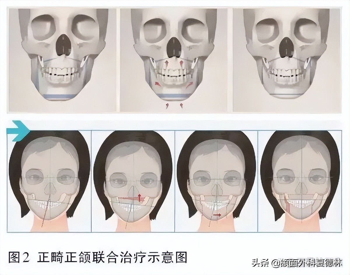 歪下巴正颌手术,颞颌关节紊乱下巴歪复位