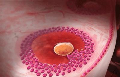 运动造成卵巢黄体破裂,跳操引起黄体破裂