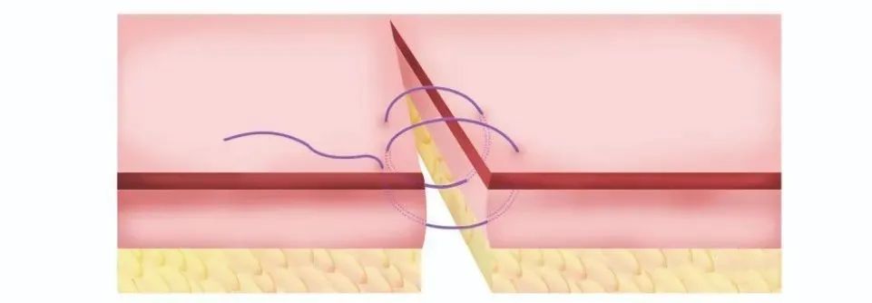 剖宫产从麻醉到伤口缝合需要多久,剖宫产伤口渗血渗液要再次缝合吗