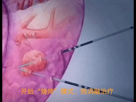 肺癌结节热消融术,肺肿瘤冷冻消融术能根治肺癌吗