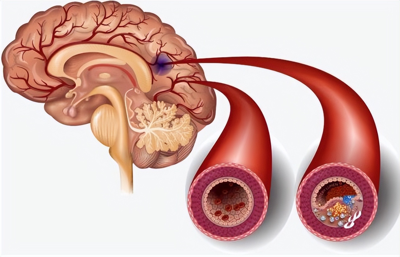 家里老人脑出血应该怎样安慰,家人脑出血自己如何调整心情