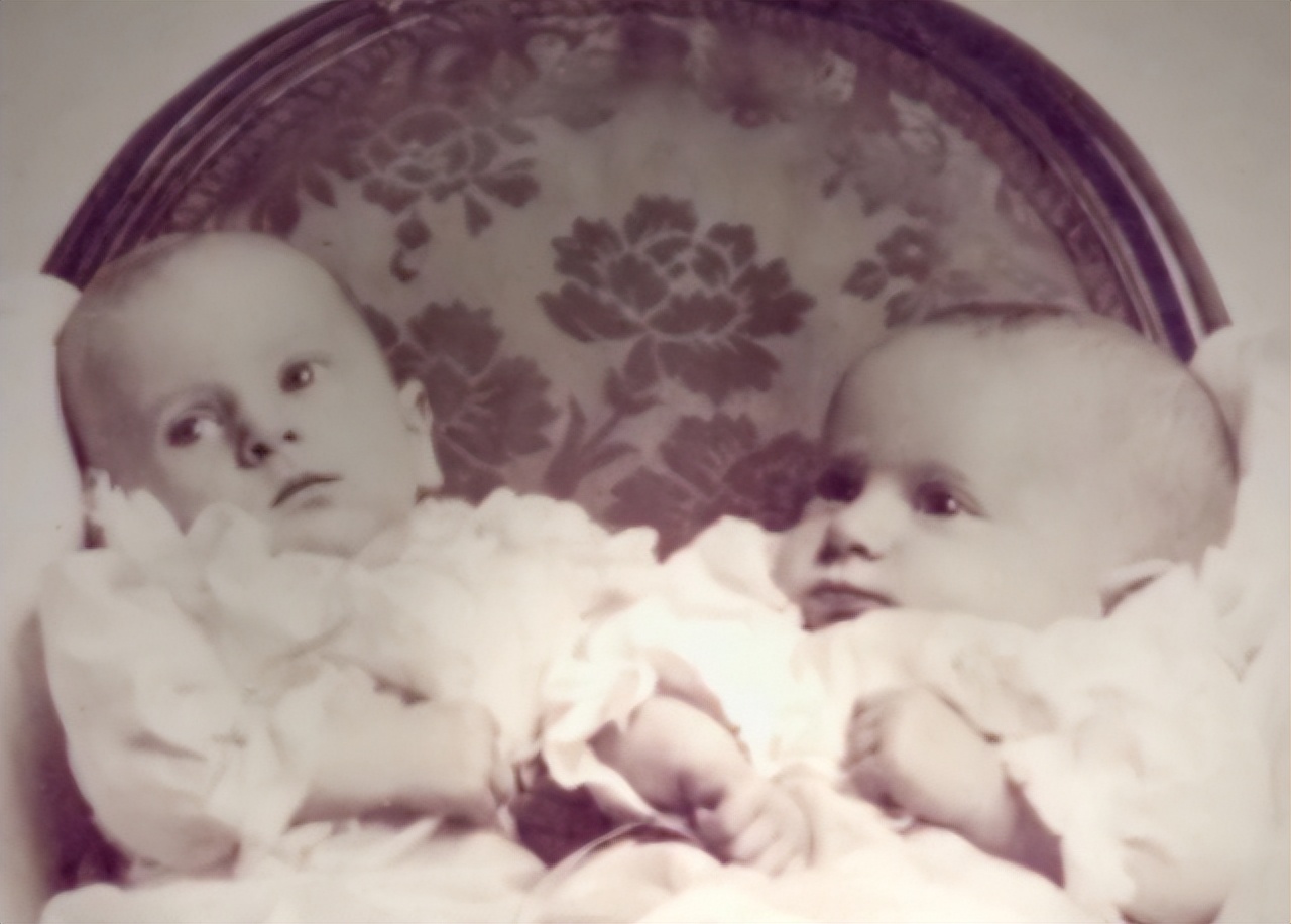 连体人一人去世了另一人会死吗,连体人死亡对另一半有影响吗