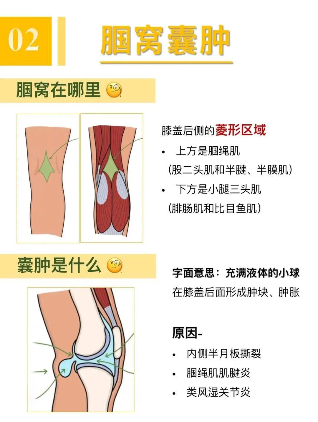 下蹲或久坐起来后腘窝疼，原因？怎么应对呢？