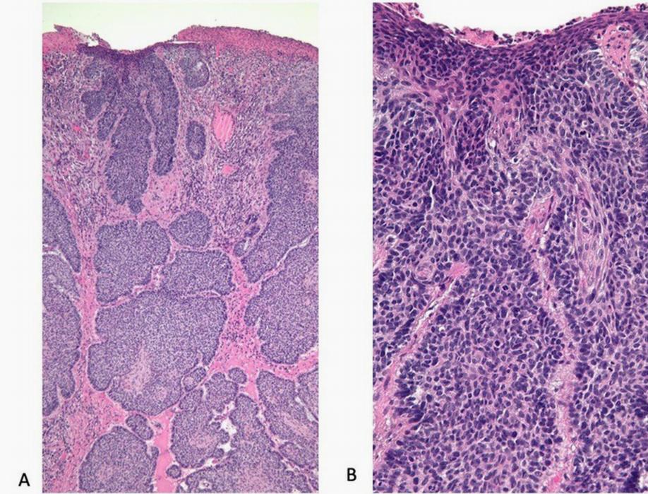 基底皮肤癌治疗手段及治愈率,基底细胞癌的中药偏方