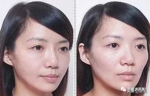 为什么整牙脸会小,为什么整牙期间脸会变老