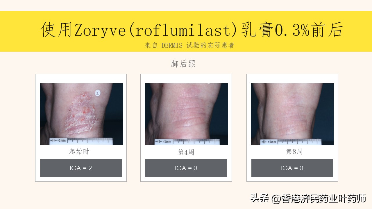 斑块状银屑病新药上市,斑块型银屑病能吃阿维a胶囊吗