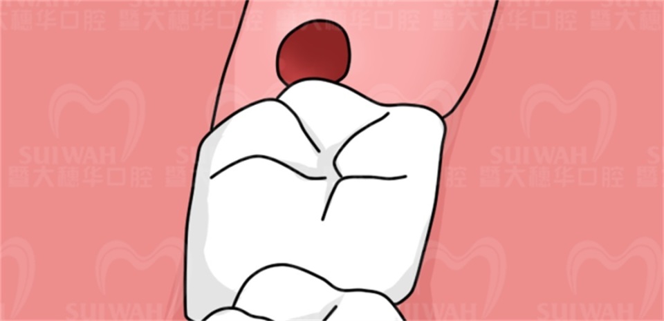 拔了下颚智齿后有个洞堆积残渣,智齿上面有个洞是补还是拔了好