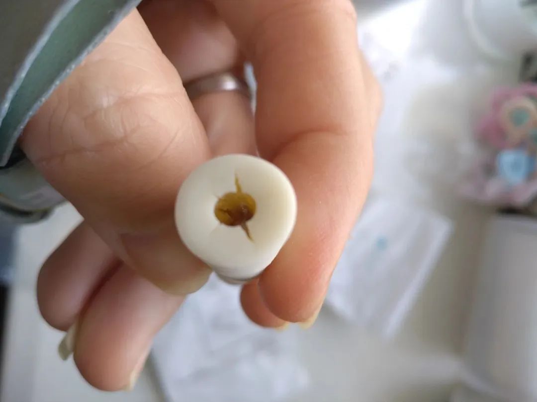 整牙亲身经历分享一下,整牙的经历分享