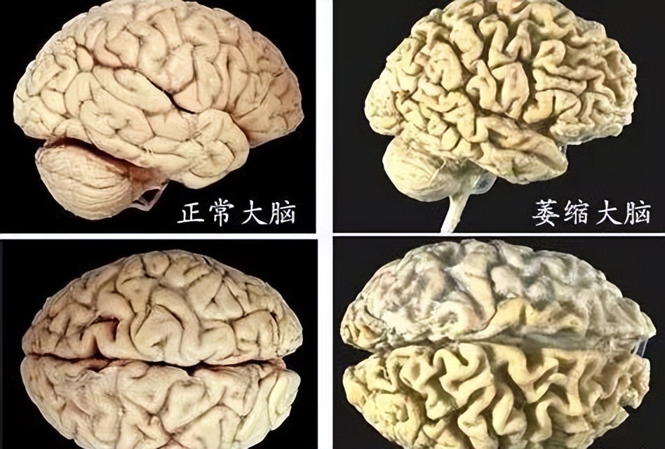 大脑发生萎缩,大脑萎缩是怎么引起的如何预防