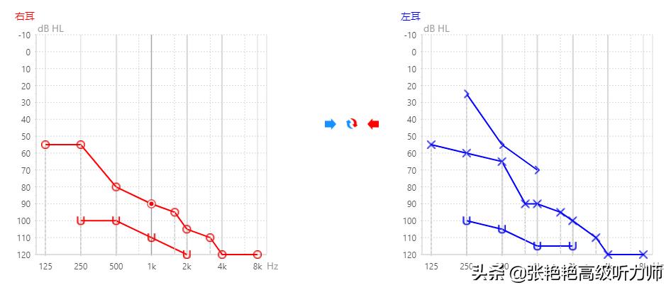 助听器到底要不要验配,选择助听器的误区