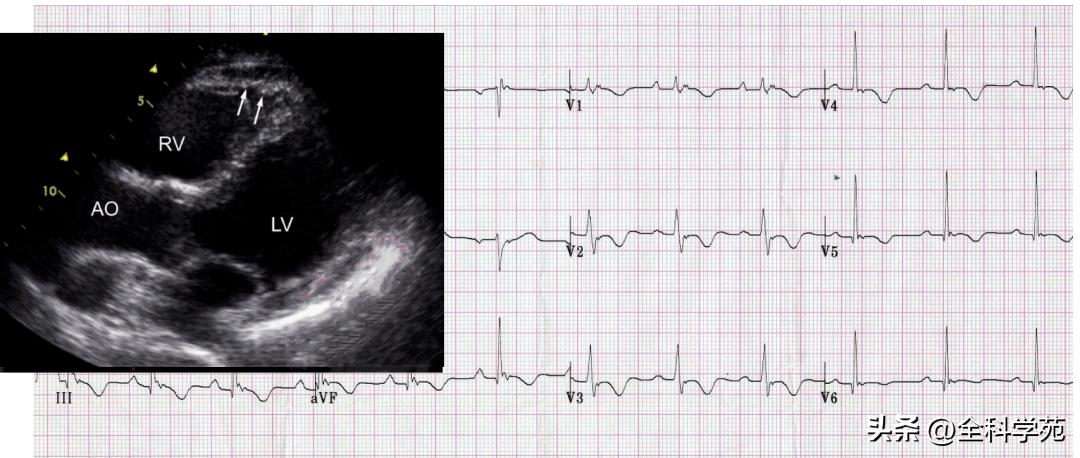 t波倒置三种常见原因,t波低平倒置有事吗