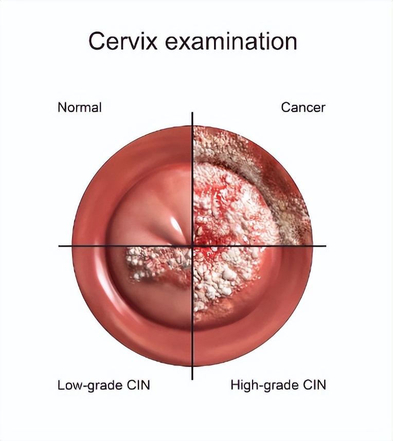 男生hpv会演变癌症吗,hpv哪几种容易致癌