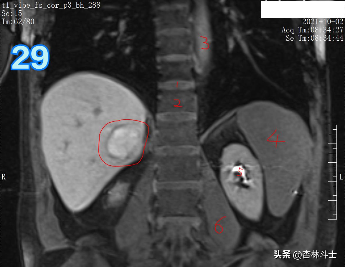 肝癌8公分肿瘤能活多久,肝癌细胞最大长多大