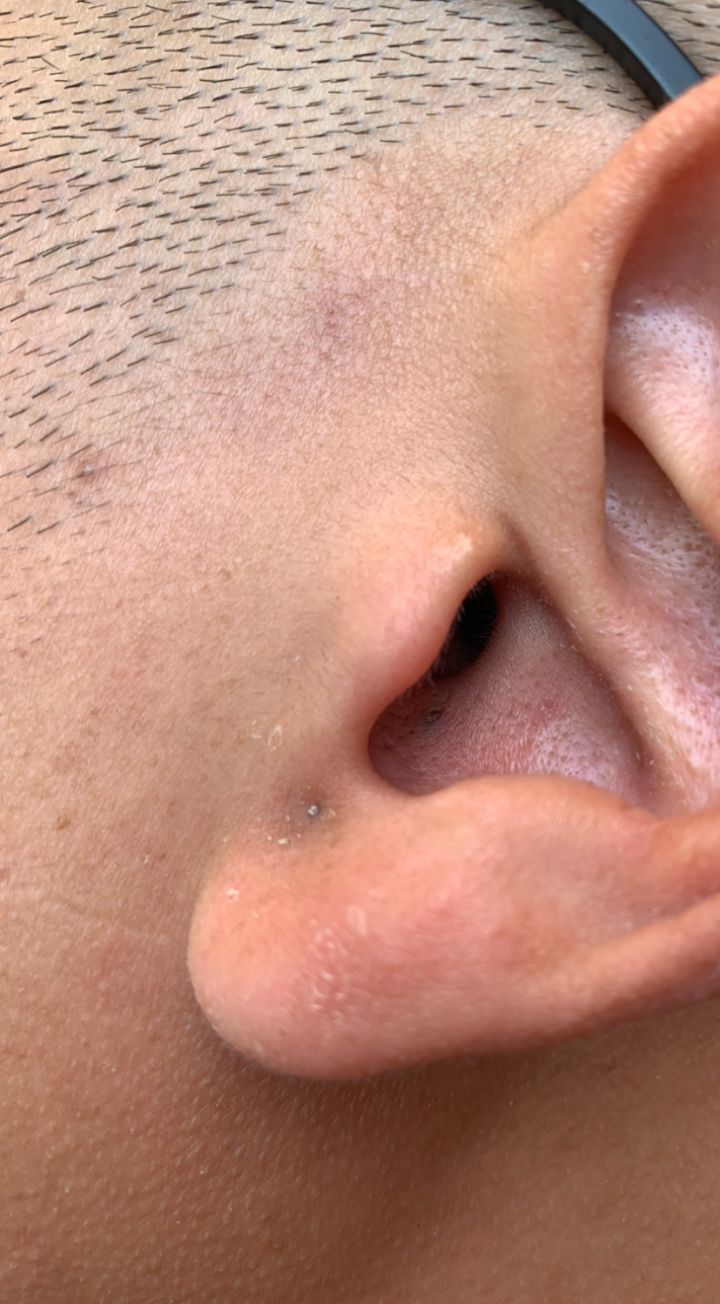 20年的黑头有多大,世界上最长的黑头到底有多长