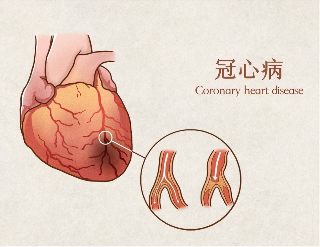 冠心病吃两种中成药效果最好,冠心病心肌缺血需要长期服药吗