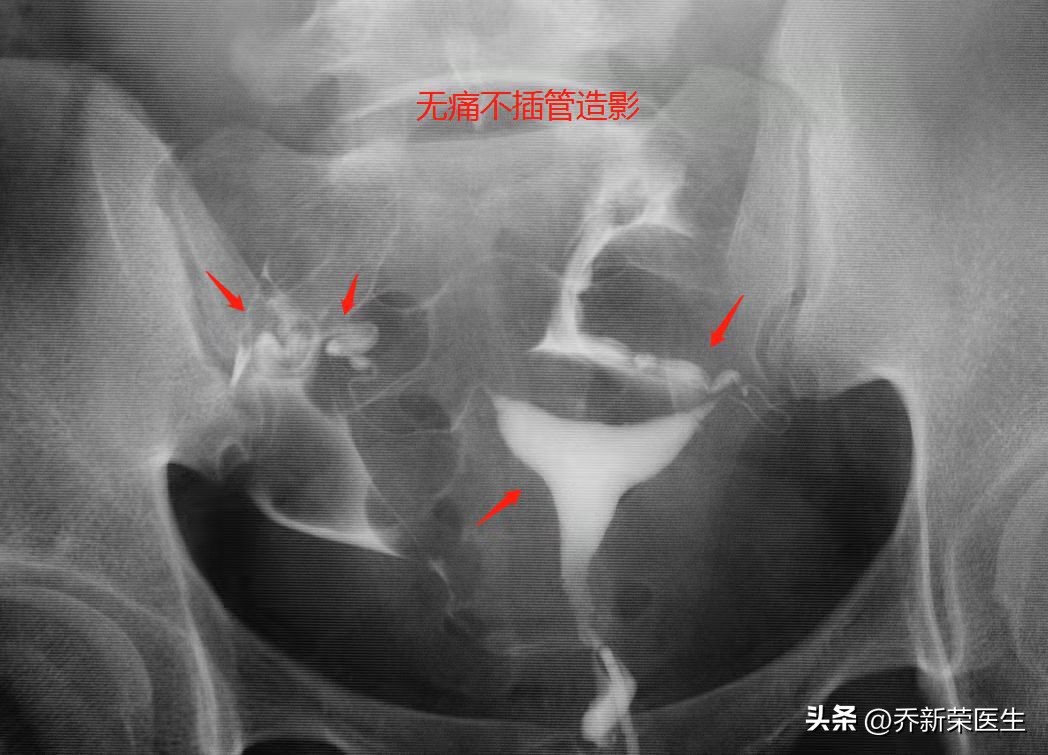 ​输卵管堵塞的症状与宫外孕的警示：理解生殖健康的两大关键