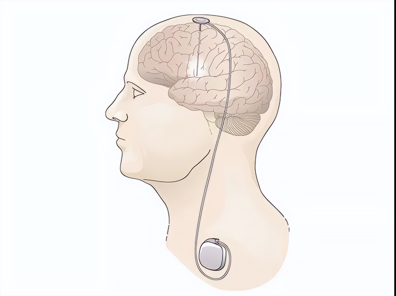 电击大脑可以提升记忆力吗,电击大脑可以忘记一个人吗