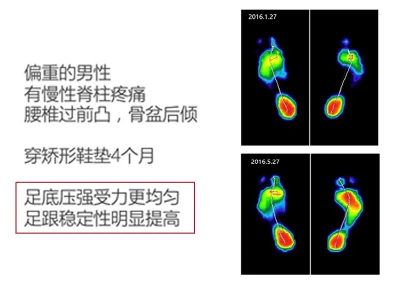 足弓消失的扁平足,改善足弓塌陷跪姿双脚要不要并拢