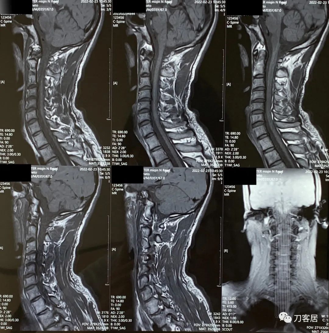 腰椎间盘突出压迫腿疼看神经内科,腰椎间盘突出看骨科还是神经内科