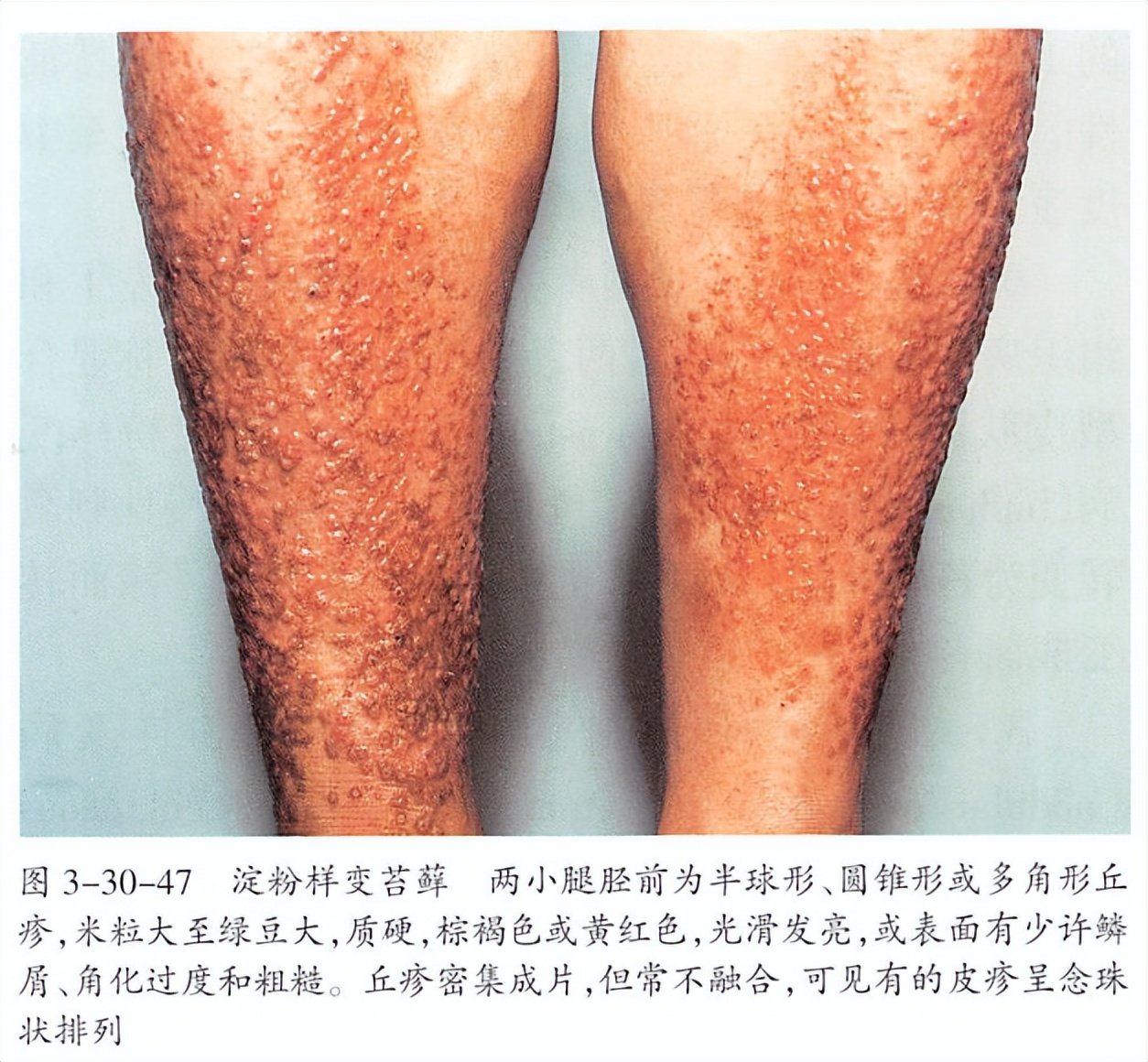 腿部长斑像烫伤一样,年轻人腿部长斑