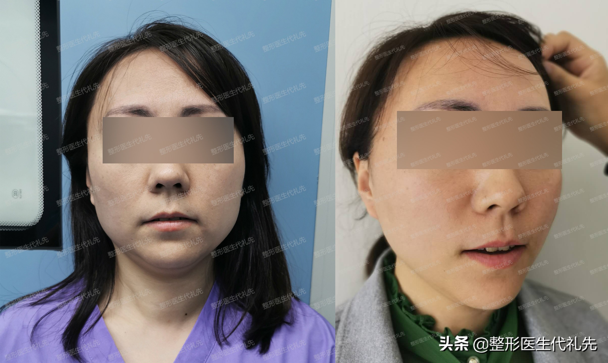 美容都打什么针能除皱,面部拉皮除皱哪家效果好