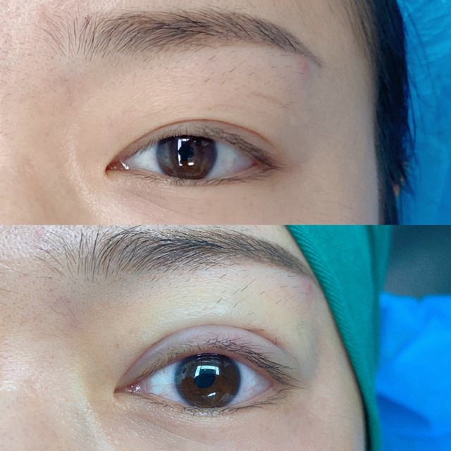 北京做双眼皮哪家医院好,北京一女子双眼皮手术照片