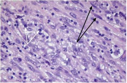 胰腺炎症性肌纤维母细胞瘤,炎症性肌纤维母细胞瘤