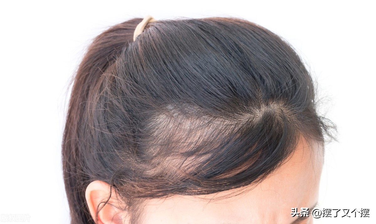 治疗头皮屑最有效的穴位,头皮屑的形成原因和去除方法