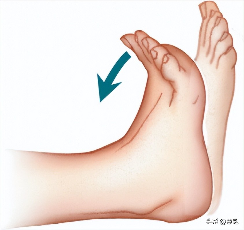 跑步减少受伤的5个方法,跑步六大伤痛解决方案