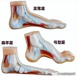 畸形脚穿什么品牌的鞋比较好,畸形脚定制鞋