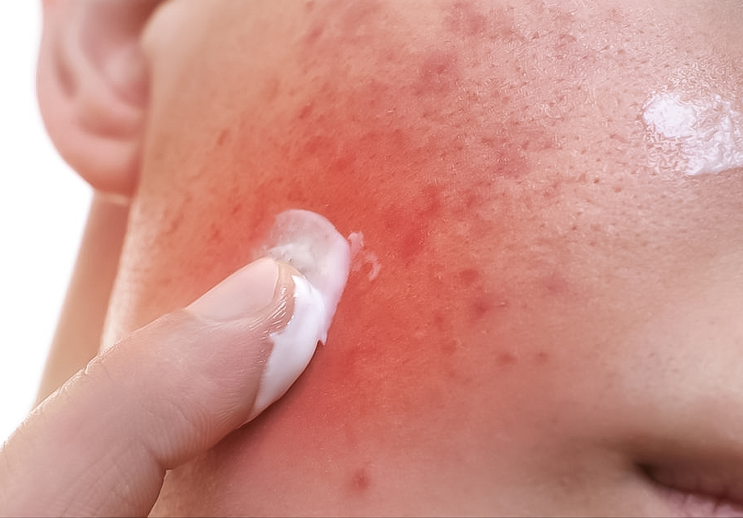 清滋颜：粉刺鼓包疼痛难受挤不住来怎么办？这里有高效处理方法