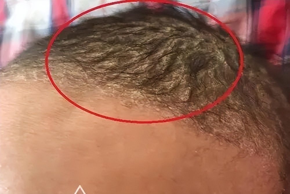 未满月的新生儿头发少还掉头发,宝宝头发稀少剃头发可以改善吗