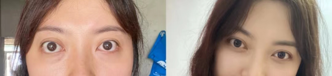 甲亢危重自救,得了甲亢怎么自救