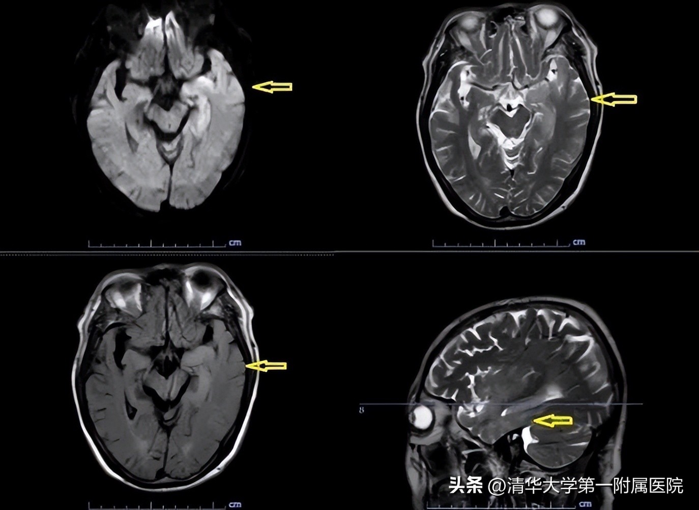 救治重症患者全力守护生命,神经内科抗击疫情
