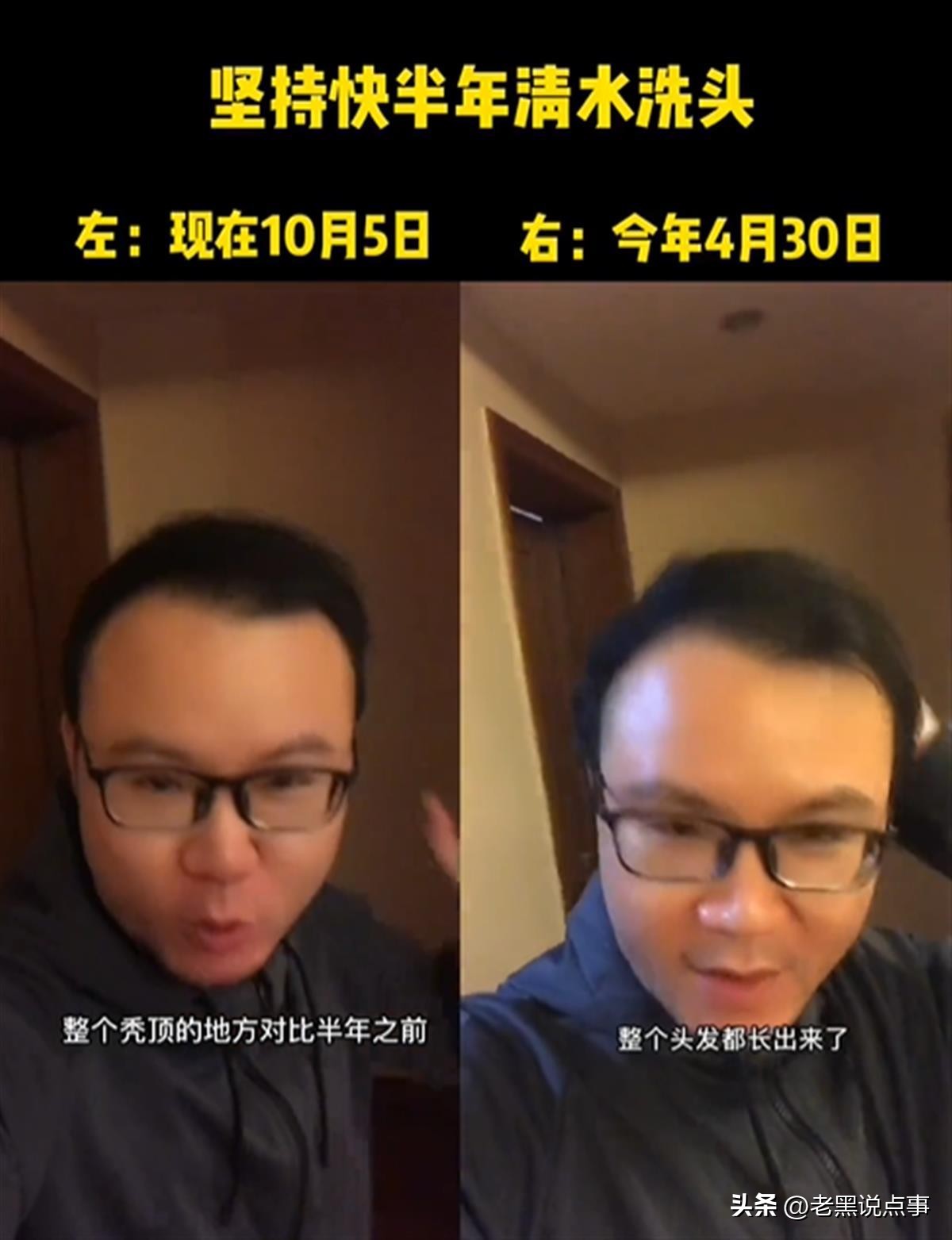 回应不用洗发水长出头发,男子不用洗发露洗头发