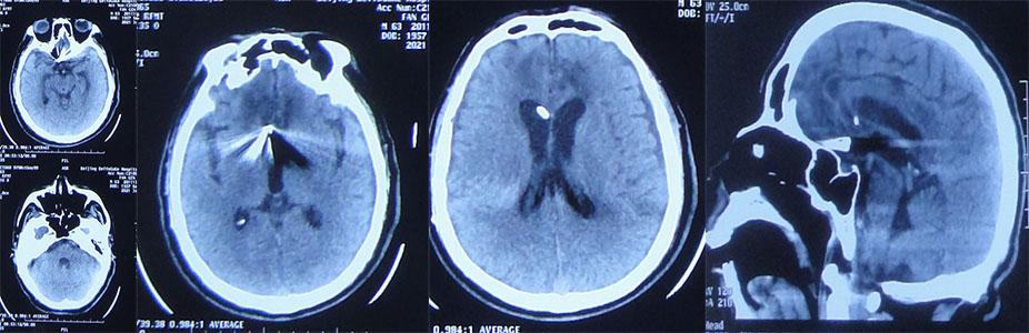 前交通动脉瘤破裂后开颅治疗风险,脑前交通动脉瘤破裂出血