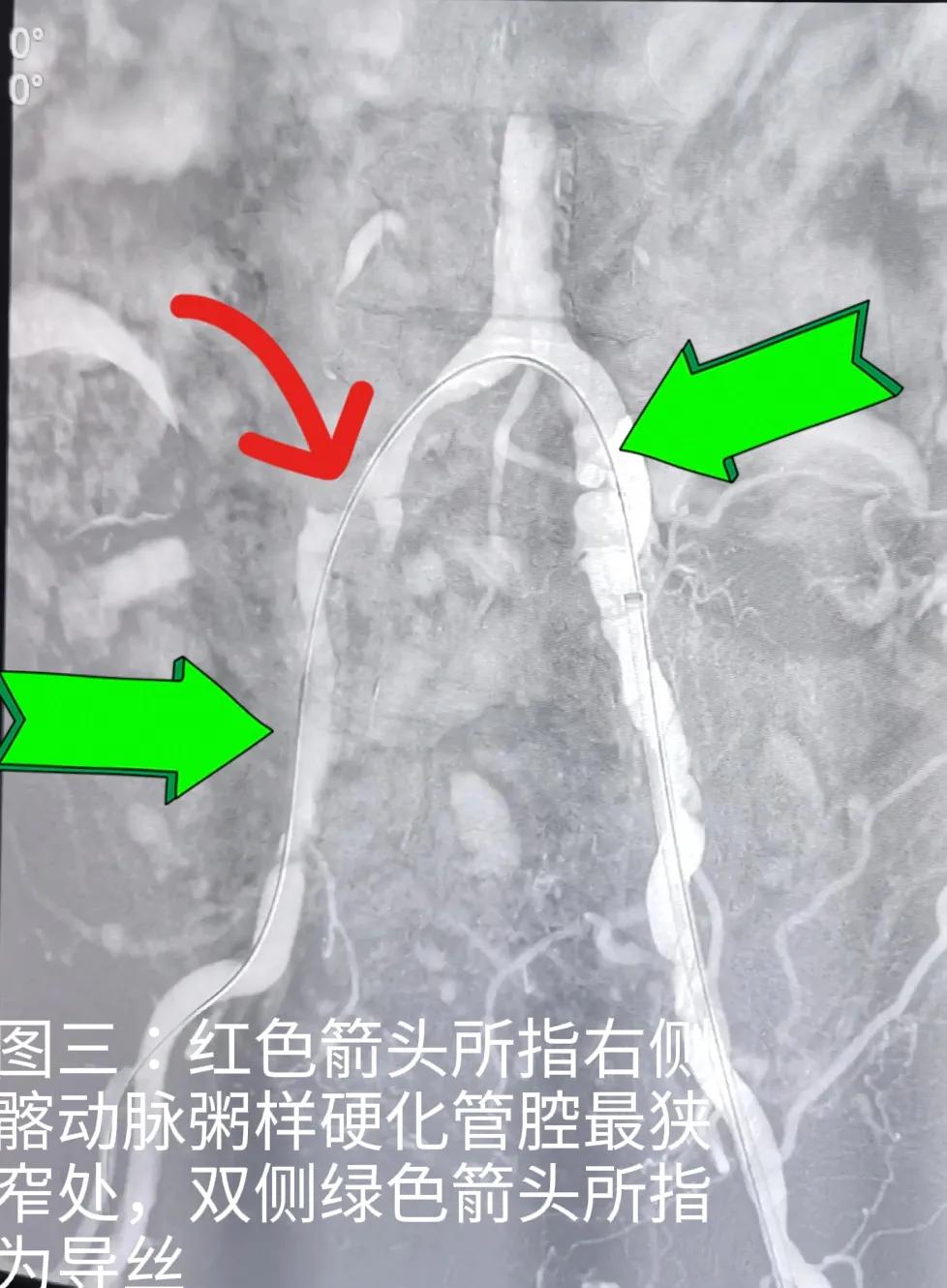 县级医院介入治疗下肢动脉硬化闭塞症